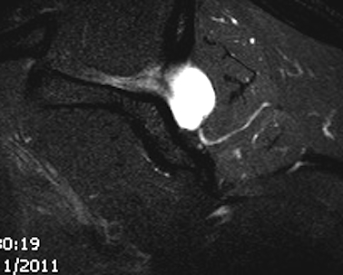 Spinoglenoid Cyst Sagittal MRI